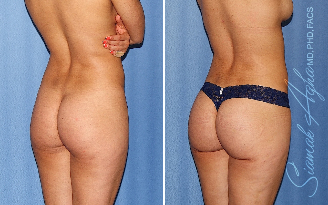 orange county brazilian butt lift patient 63 back right Newport Beach, CA