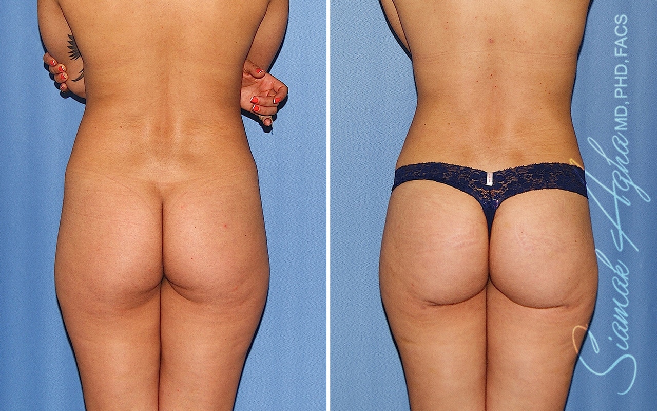 orange county brazilian butt lift patient 63 back Newport Beach, CA