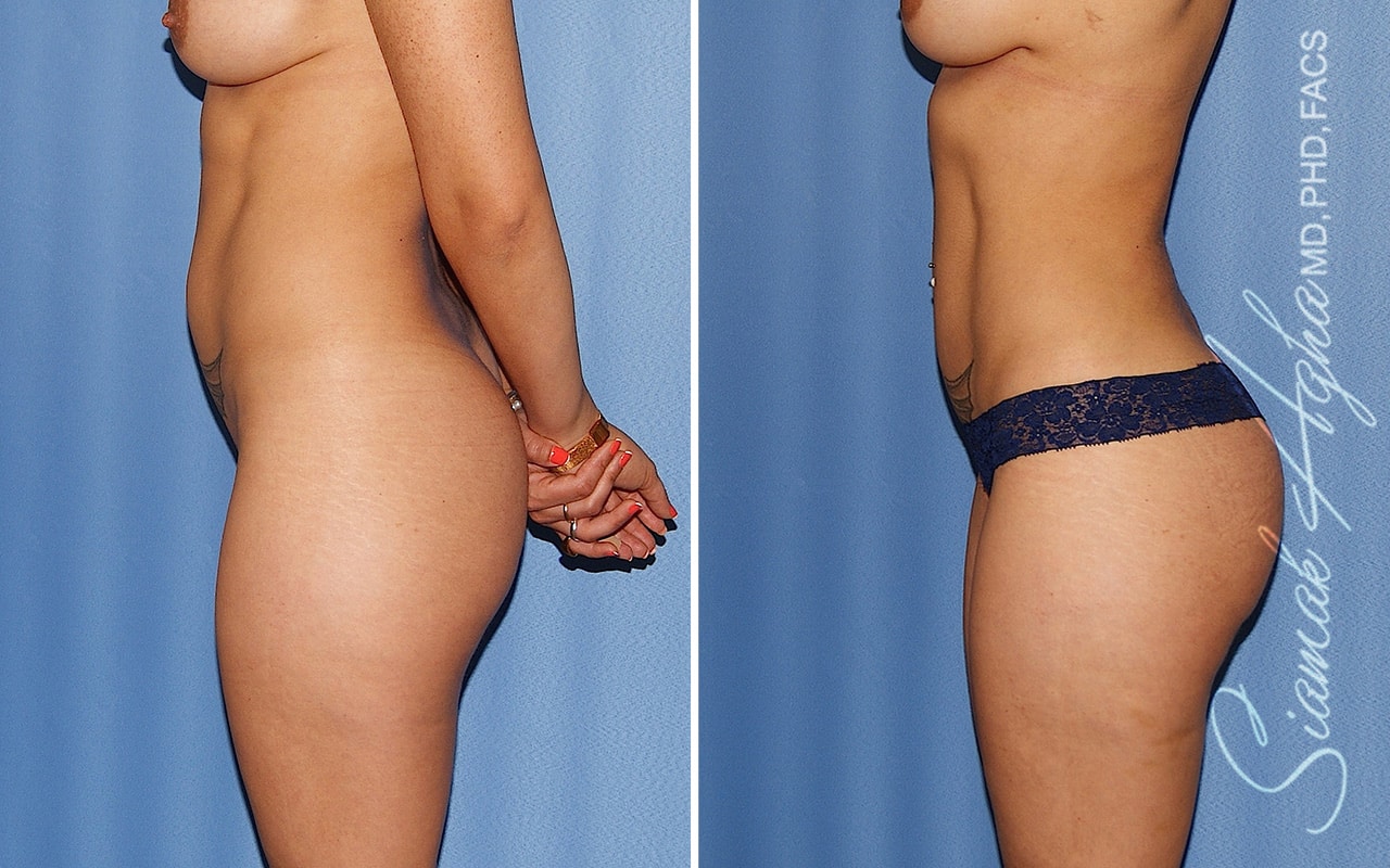 orange county brazilian butt lift patient 63 left Newport Beach, CA