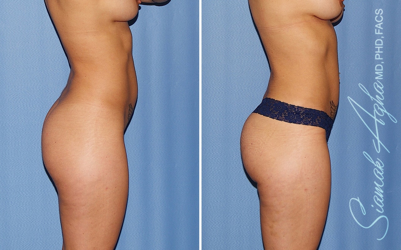 orange county brazilian butt lift patient 63 right Newport Beach, CA