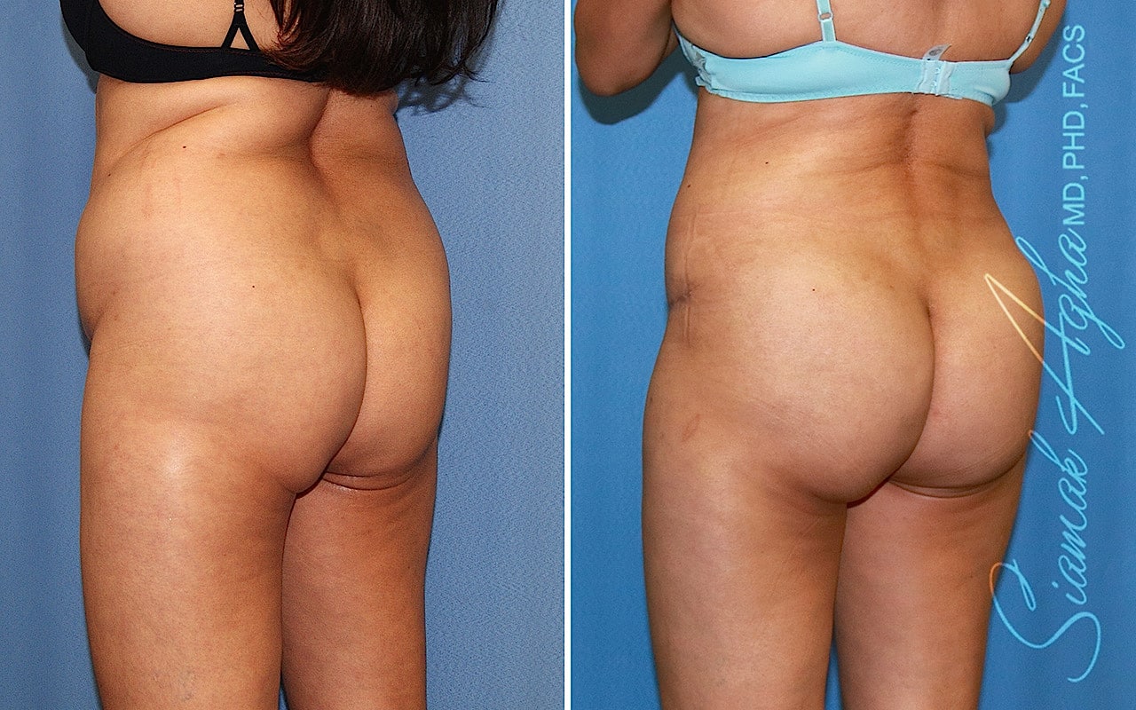 orange county brazilian butt lift patient 67 back left Newport Beach, CA