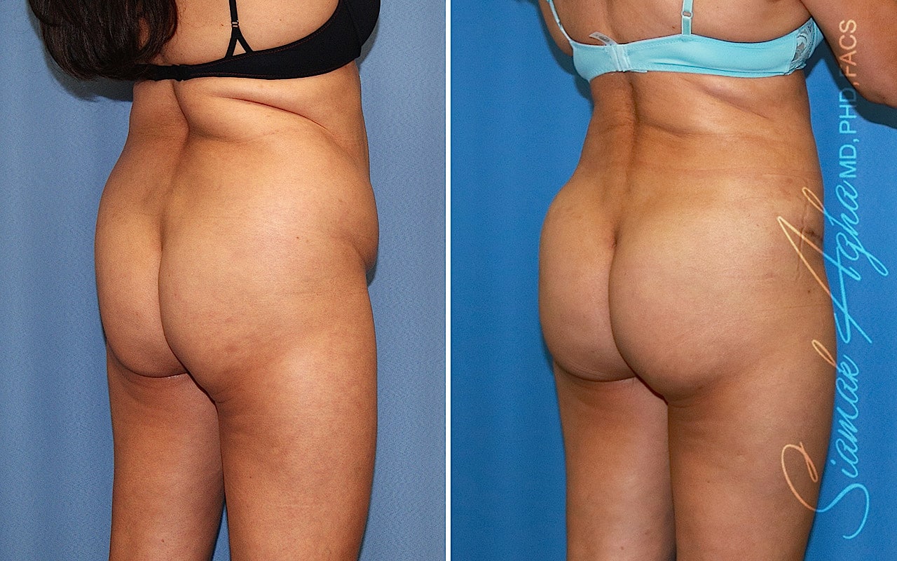 orange county brazilian butt lift patient 67 back right Newport Beach, CA