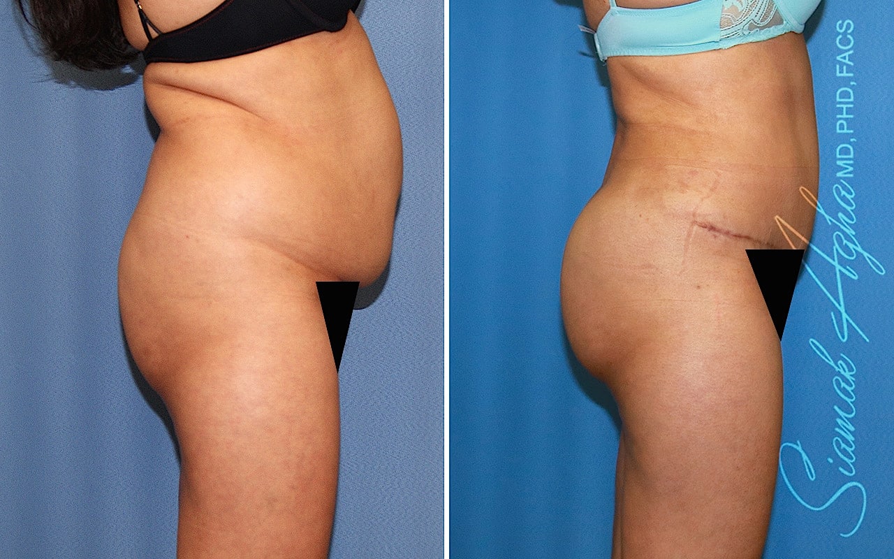 orange county brazilian butt lift patient 67 right Newport Beach, CA