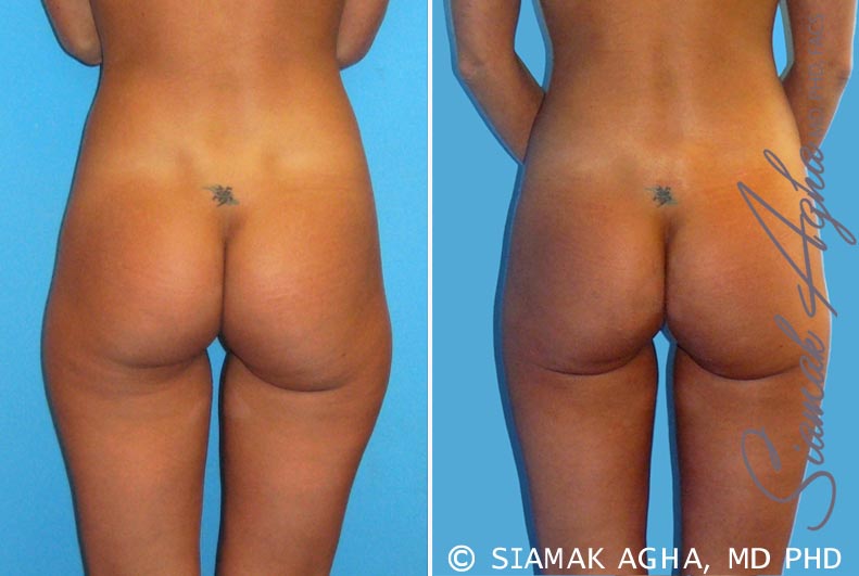 orange county brazilian butt lift patient 7 back Newport Beach, CA