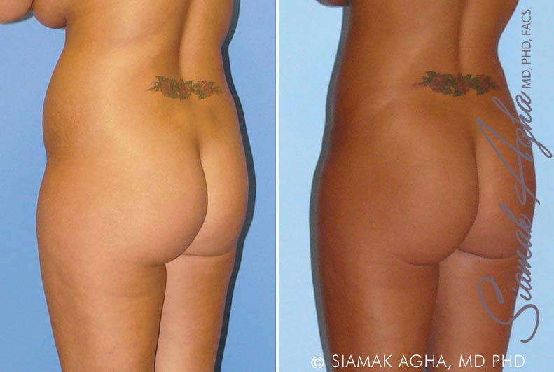 orange county brazilian butt lift patient 8 back left Newport Beach, CA