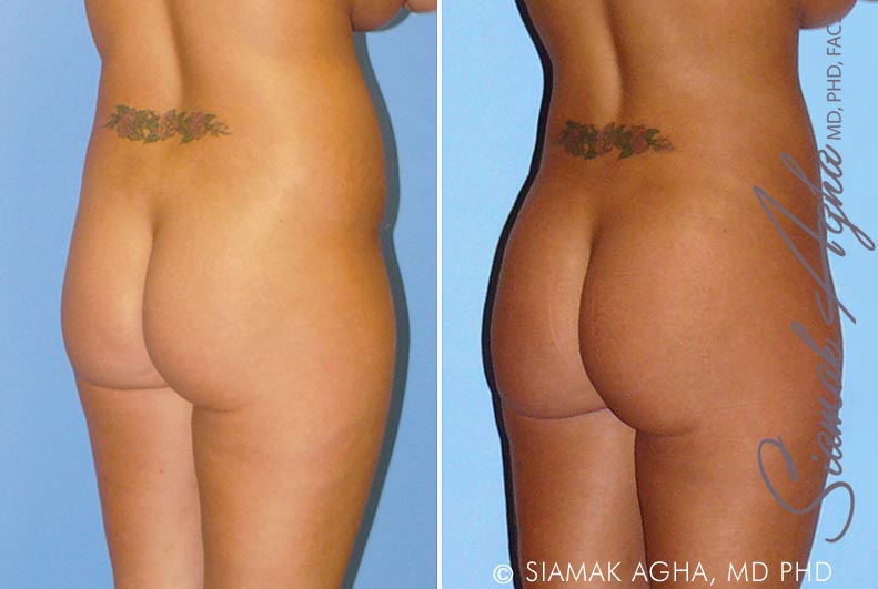 orange county brazilian butt lift patient 8 back right Newport Beach, CA