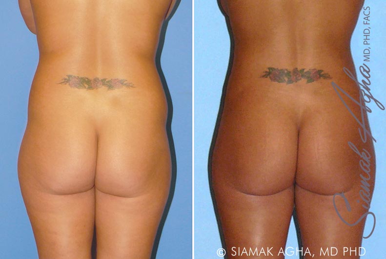 orange county brazilian butt lift patient 8 back Newport Beach, CA