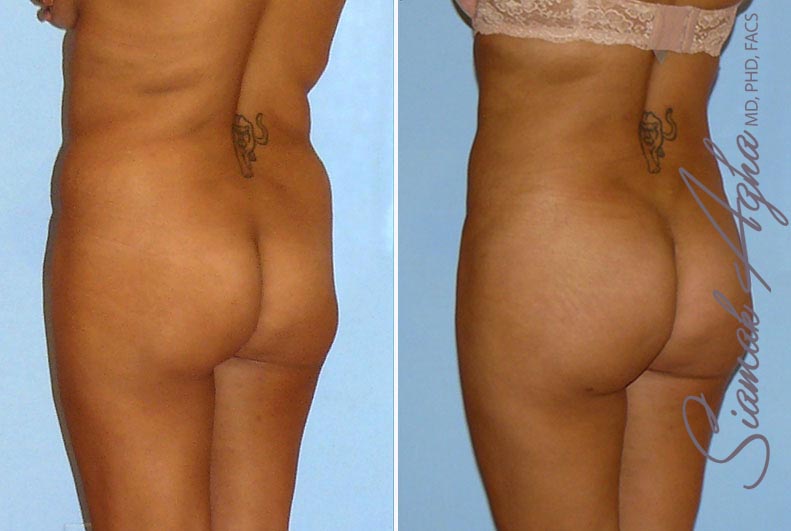 orange county brazilian butt lift patient 9 back left Newport Beach, CA