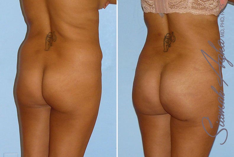 orange county brazilian butt lift patient 9 back right Newport Beach, CA