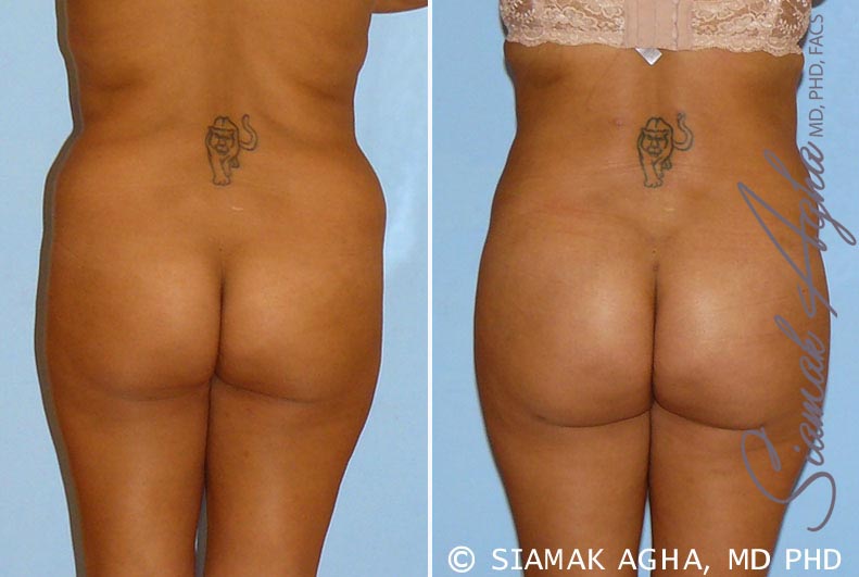 orange county brazilian butt lift patient 9 back Newport Beach, CA