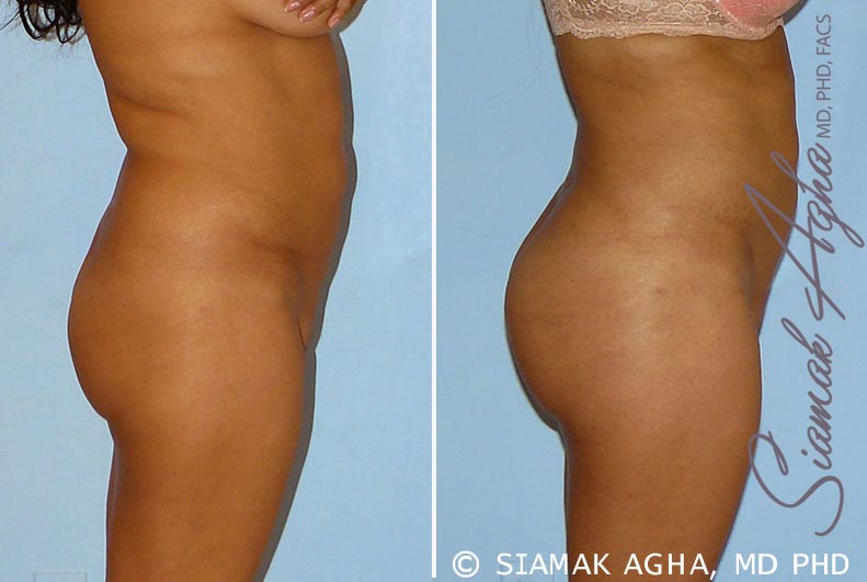 orange county brazilian butt lift patient 9 right Newport Beach, CA