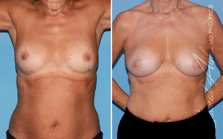 Breast Fat Transfer