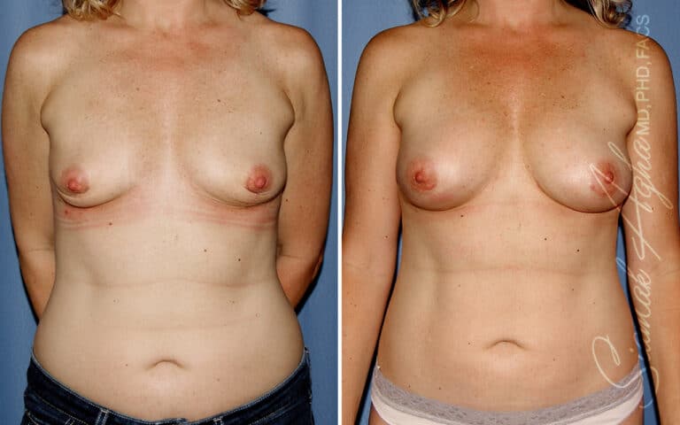 Breast Fat Transfer