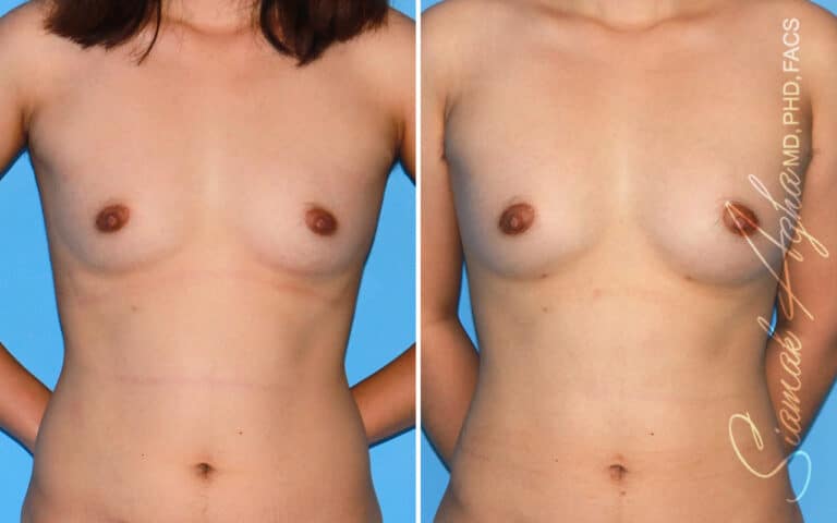 Breast Fat Transfer