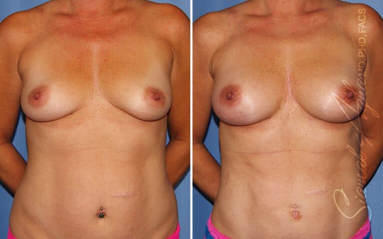 Breast Fat Transfer