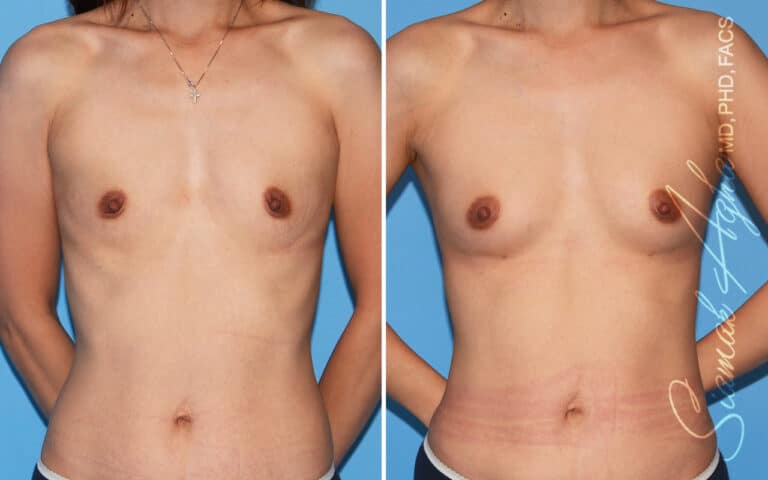 Breast Fat Transfer