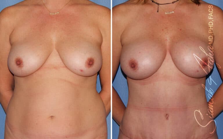 Breast Fat Transfer