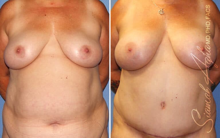 Breast Fat Transfer