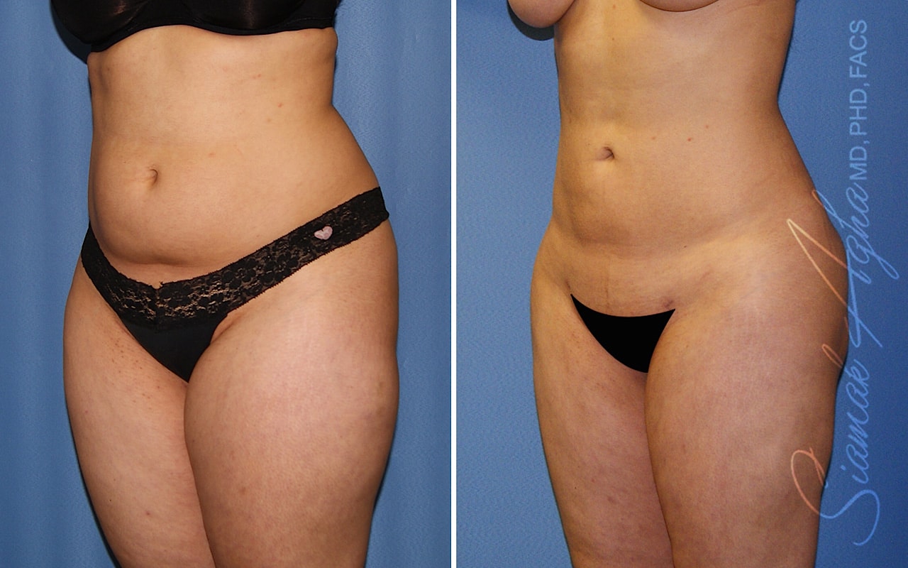 orange county liposuction patient 26 front left Newport Beach, CA