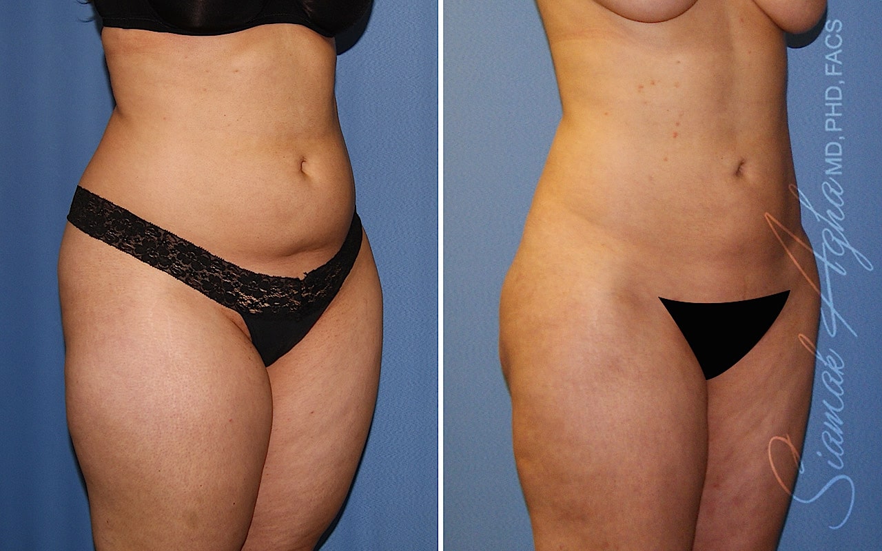 Orange County Liposuction Patient 26 Front Right Newport Beach, CA