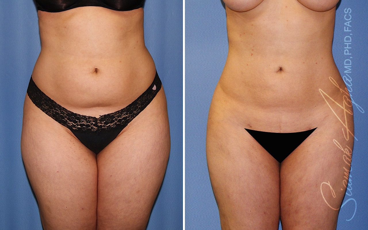 orange county liposuction patient 26 front Newport Beach, CA