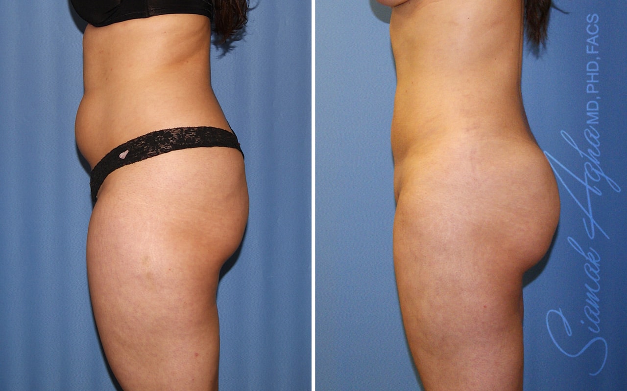 Orange County Liposuction Patient 26 Left Newport Beach, CA