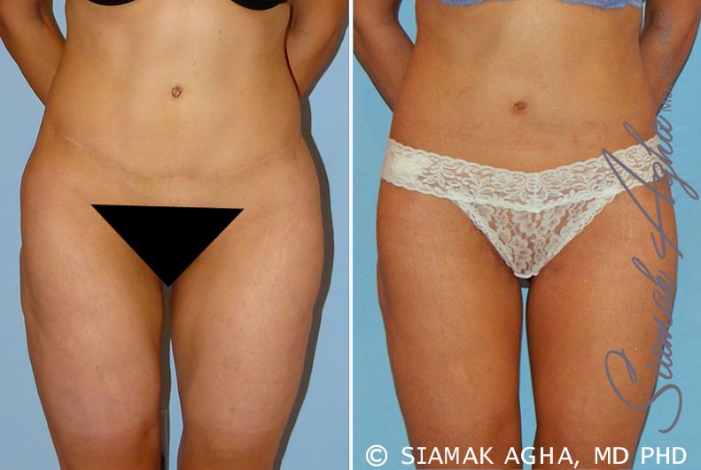 Orange County Spiral Thigh Lift Patient 4 Front Newport Beach, CA