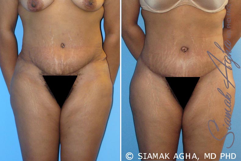 Tummy Tuck Revision