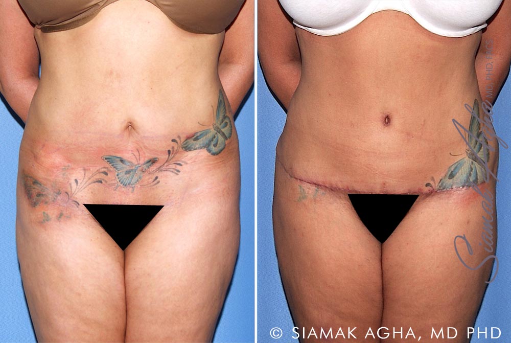 Tummy Tuck Revision