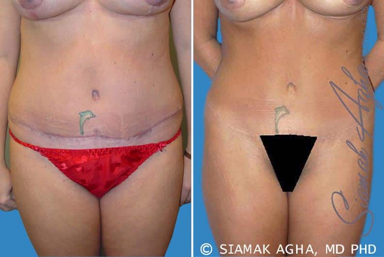 Tummy Tuck Revision