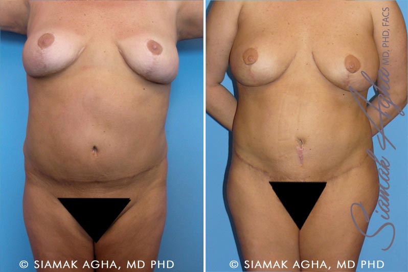 Tummy Tuck Revision