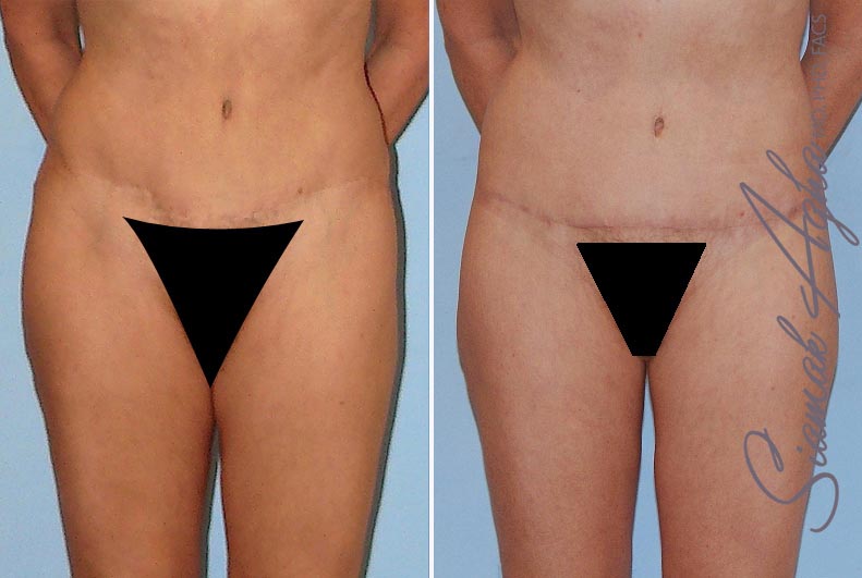 Tummy Tuck Revision