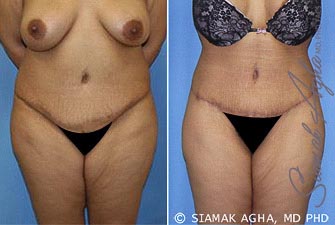 Tummy Tuck Revision