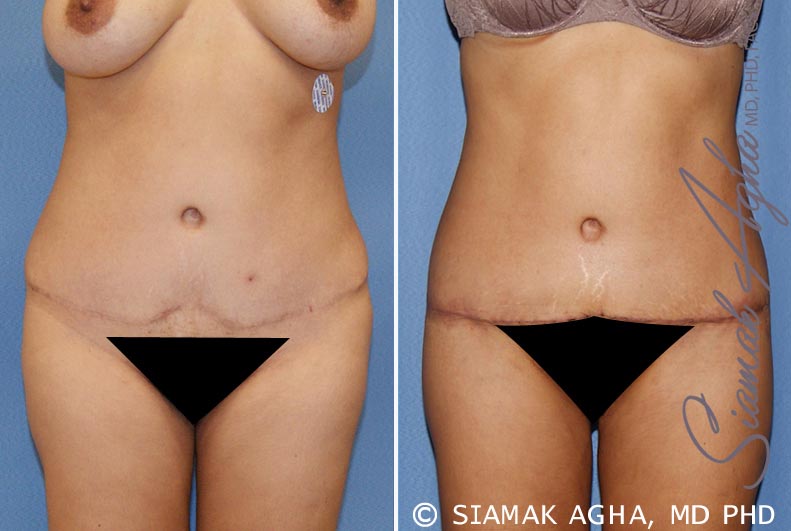 Tummy Tuck Revision