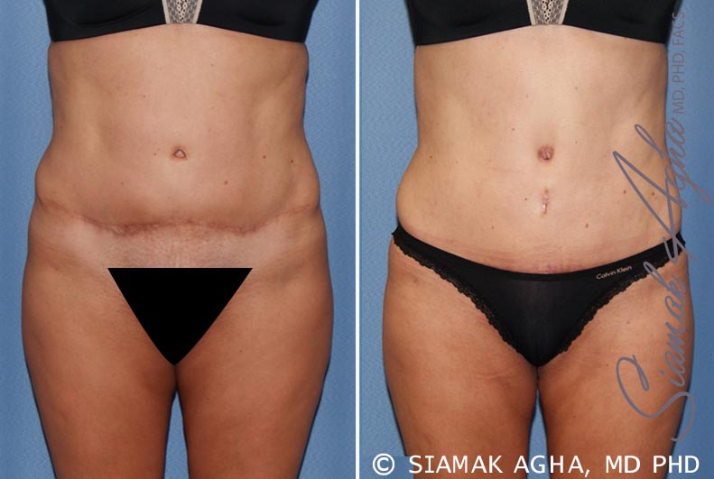 Tummy Tuck Revision