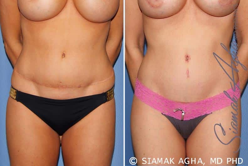 Tummy Tuck Revision