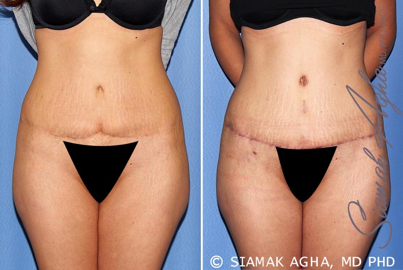 Tummy Tuck Revision