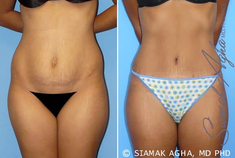 Tummy Tuck