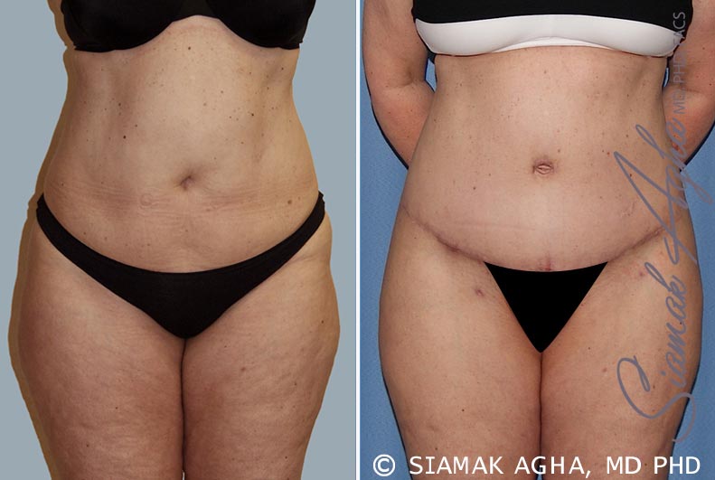 Tummy Tuck