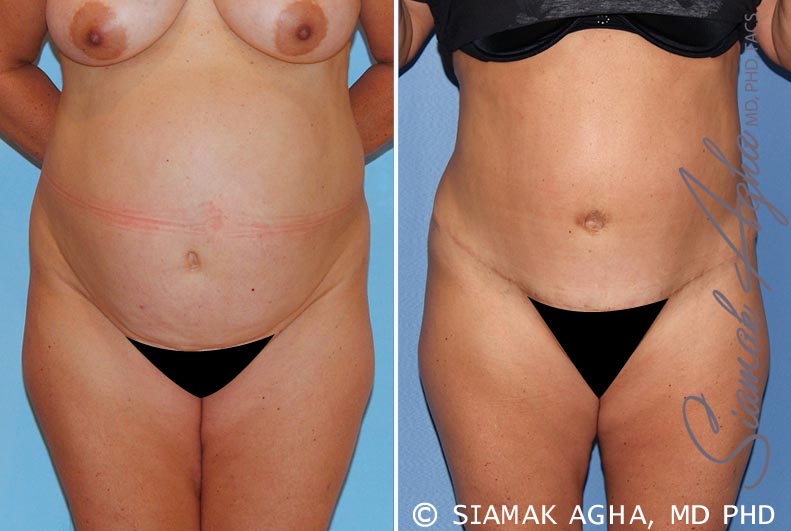 Tummy Tuck