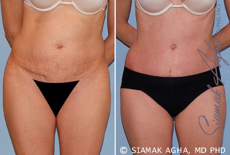 Tummy Tuck