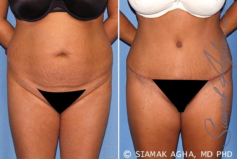 Tummy Tuck