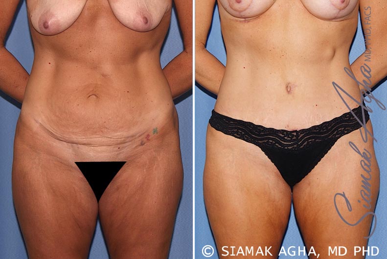 Tummy Tuck