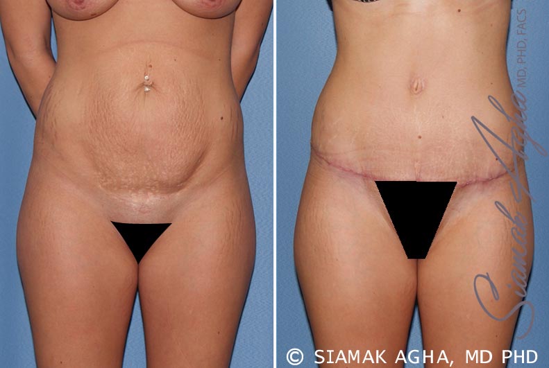 Tummy Tuck