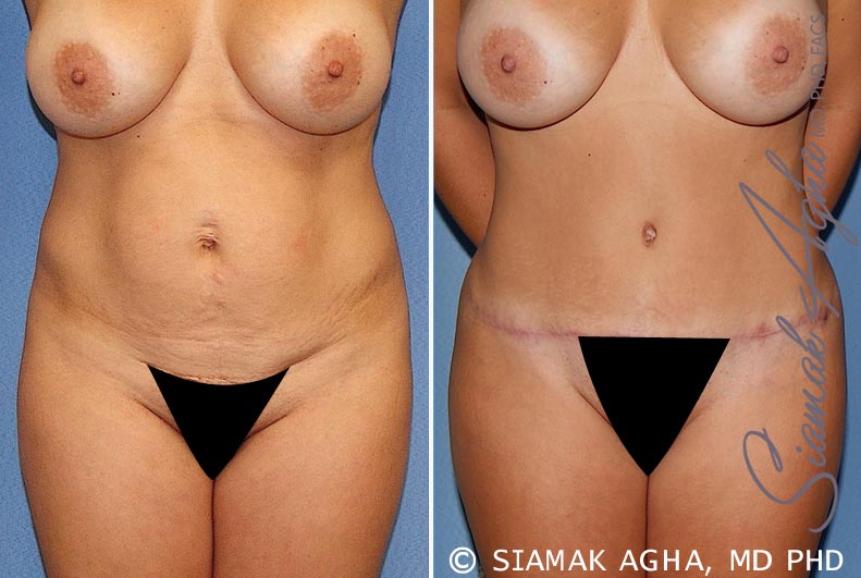 Tummy Tuck