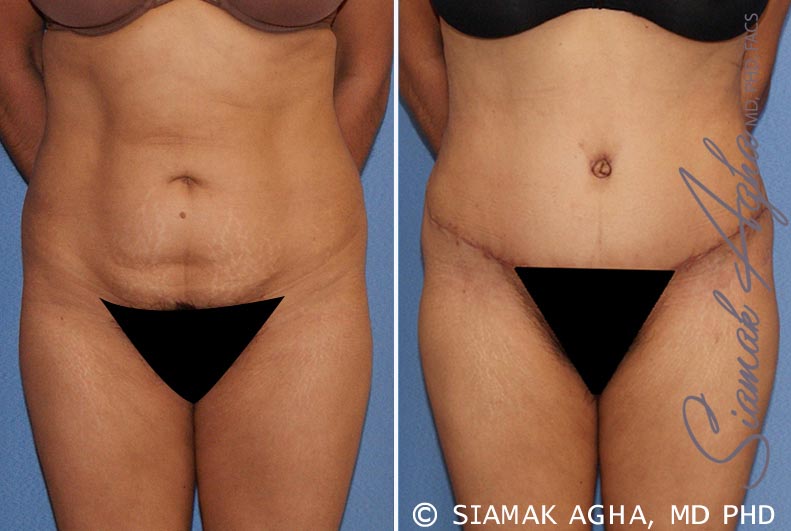 Tummy Tuck