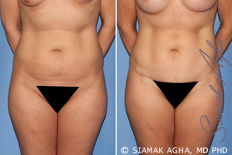 Tummy Tuck