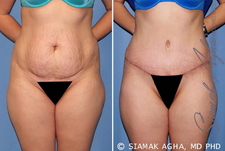 Tummy Tuck