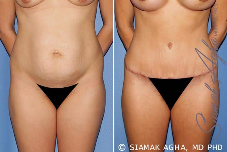 Tummy Tuck