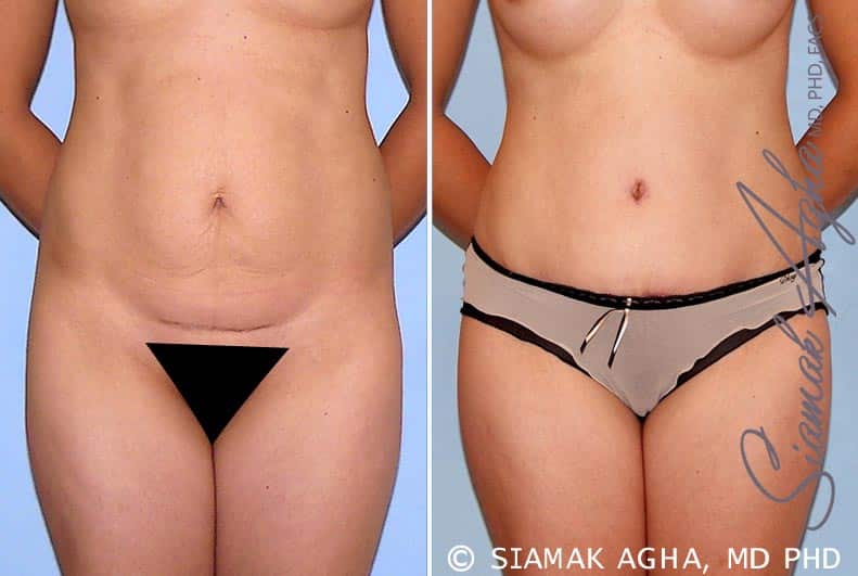 Tummy Tuck